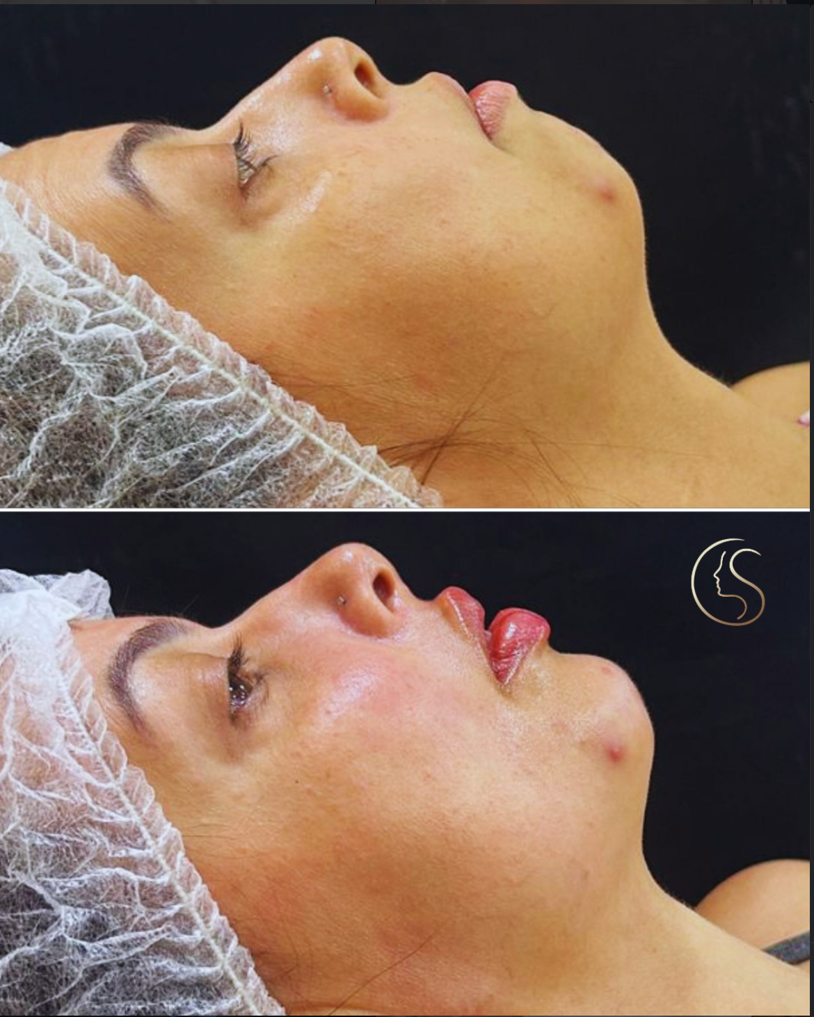 Resultado preenchimento labial — antes e depois