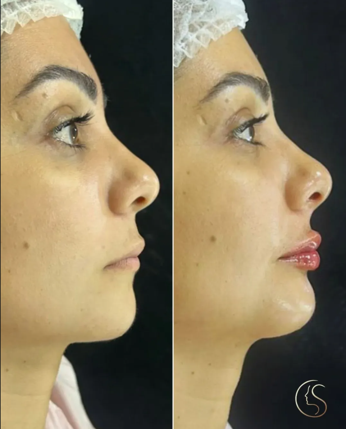 Resultado preenchimento labial — antes e depois