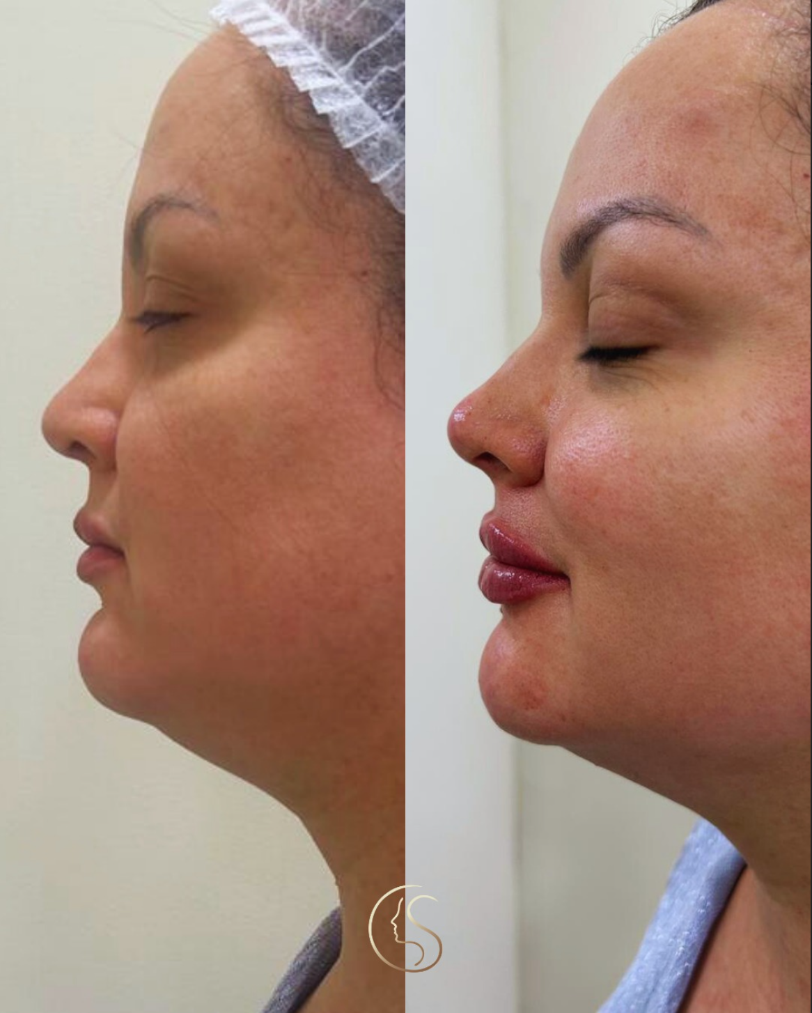 Resultado harmonização facial — antes e depois