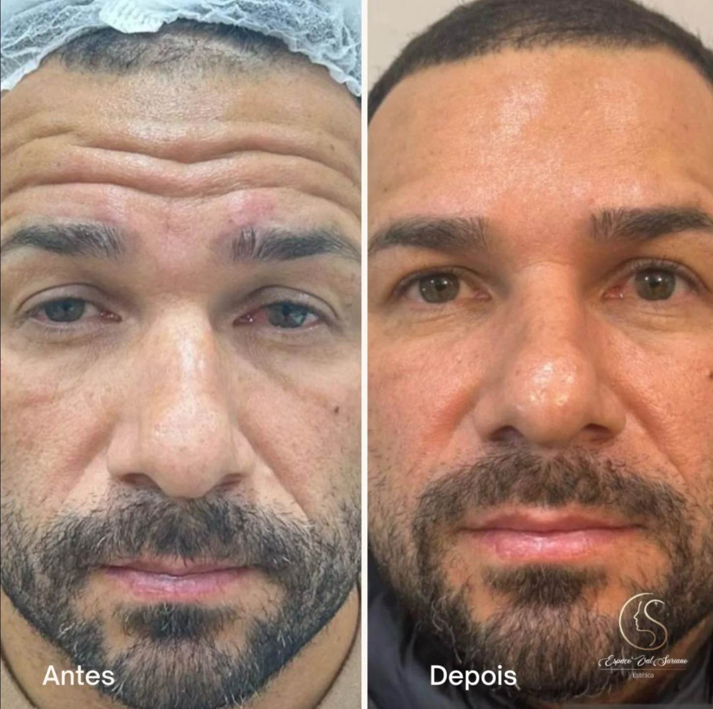 Resultado botox — antes e depois