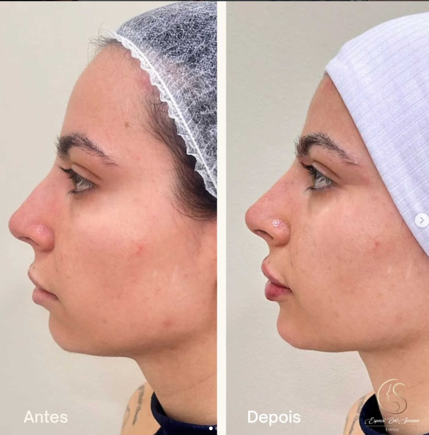 Resultado harmonização facial — antes e depois